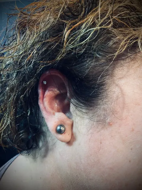 Stretched lobe with a plug, by Chandre Louw